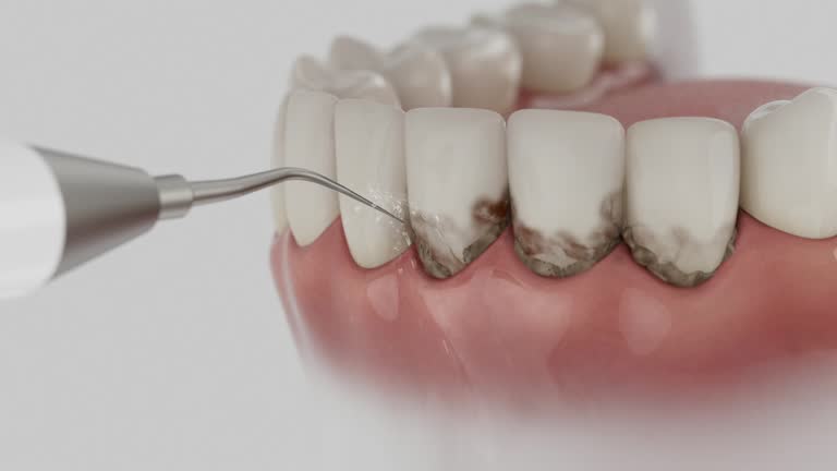 Trusted Wisdom Tooth Removal service in King City, OR - Dentist Open Now